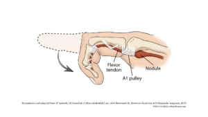 Read more about the article Trigger Finger…Are You At Risk?